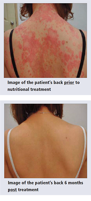 psoriasis is an inflammatory skin condition