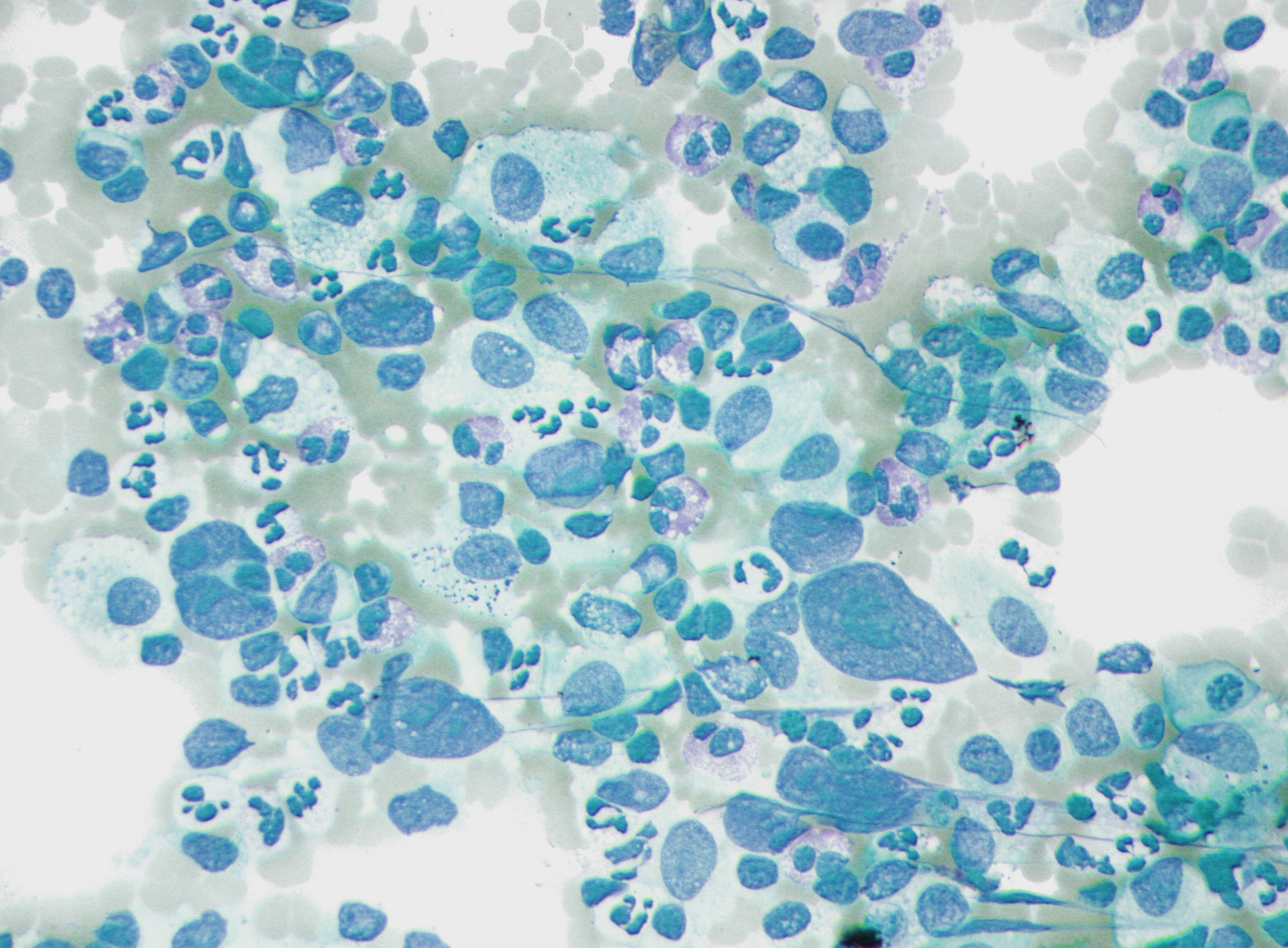 Microscope image showing a mixture of cells common in Hodgkin's lymphoma
